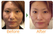 2BバイオトリートメントエステのBeforeAfter